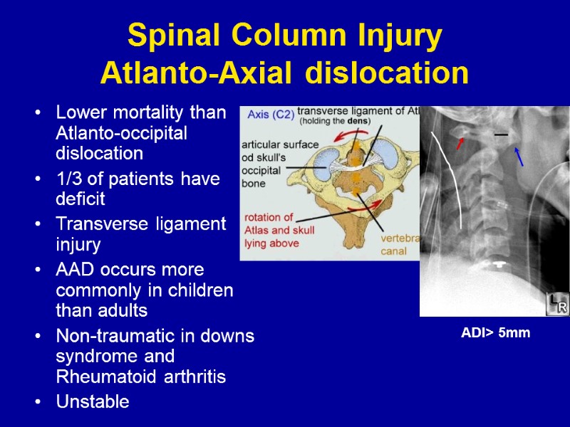 Spinal Column Injury Atlanto-Axial dislocation Lower mortality than Atlanto-occipital dislocation 1/3 of patients have